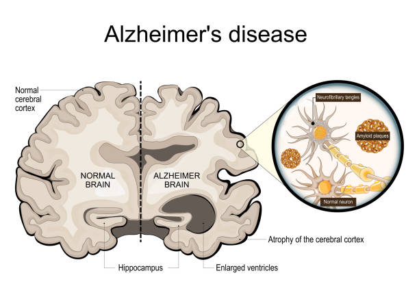 Graphic illustration of how Alzheimer's disease affects human brain