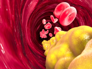 Cholesterol in blood vessel